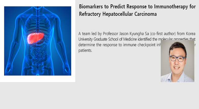 Biomarkers to Predict Response to Immunotherapy for Refractory Hepatocellular Carcinoma